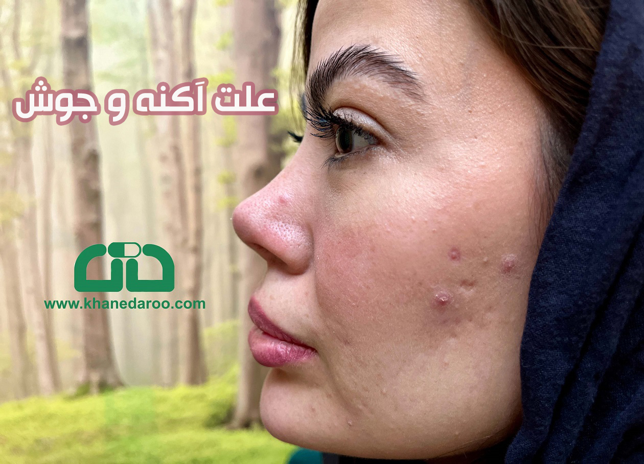 علت آکنه یا جوش هورمونی چیست؟
